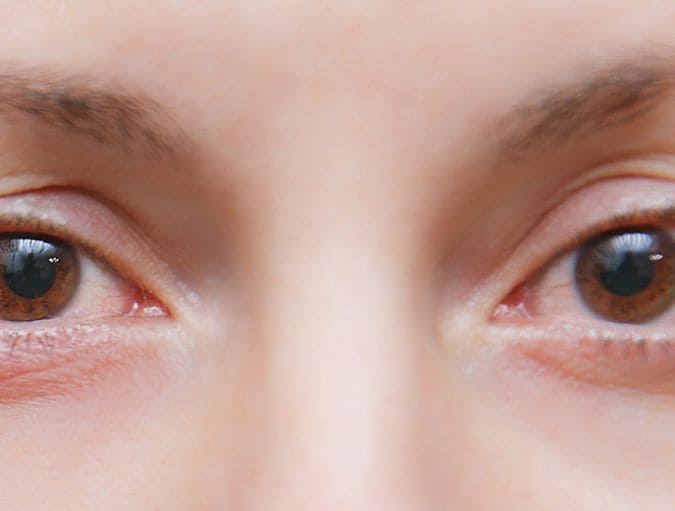 A_stye_(hordeolum)_and_lenses_row_1