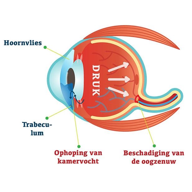 What_is_glaucoma?_row_3
