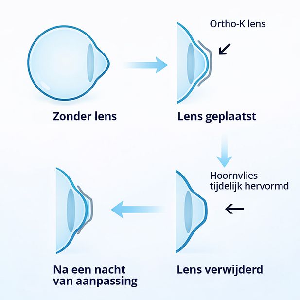 Diagram van de vorm van een oog, voor, tijdens en na het dragen van Ortho-K lenzen